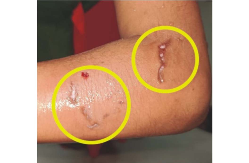 বরুড়ায় পাগলা কুকুরের কামড়ে ৩০ জন আহত
